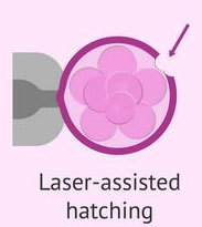laser-assisted-hatching