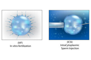 IVF-ICSI