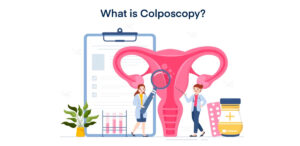 کولپوسکوپی چیست؟