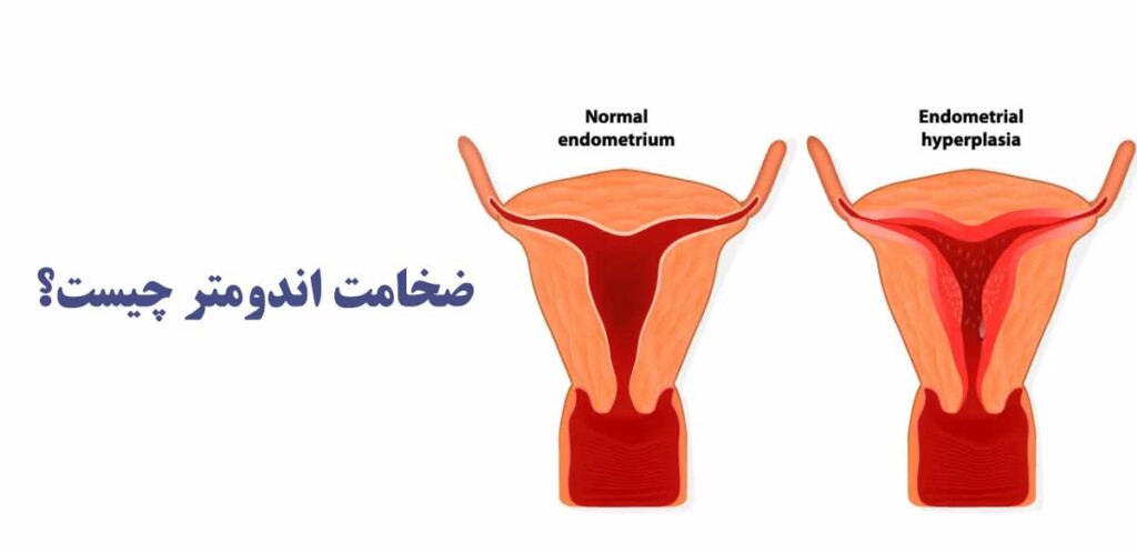 ضخامت اندومتر