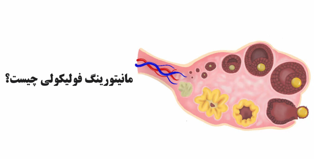 مانیتورینگ فولیکولی