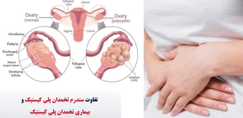 تخمدان پلی کیستیک