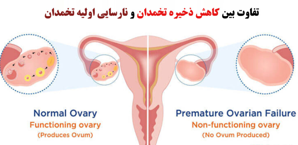 ذخیره تخمدان