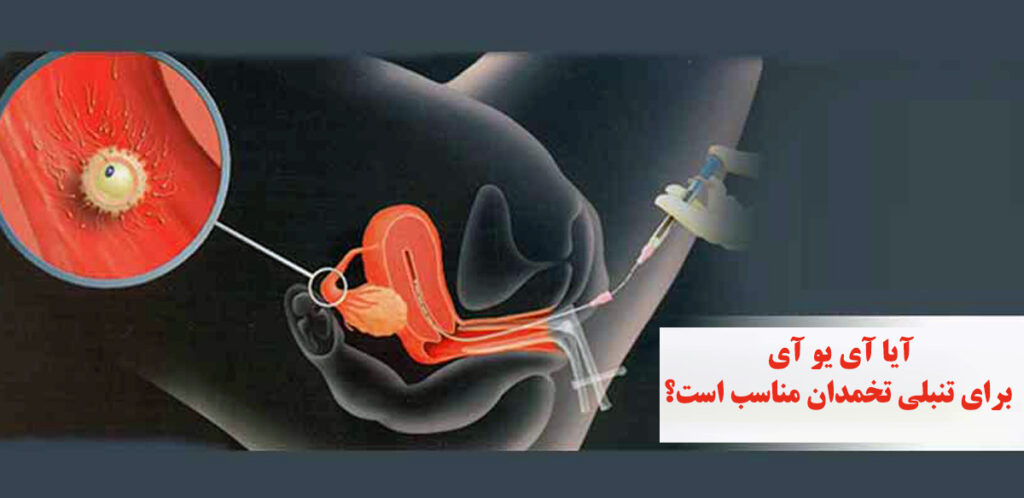 تنبلی تخمدان