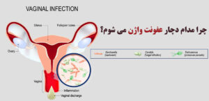 عفونت واژن