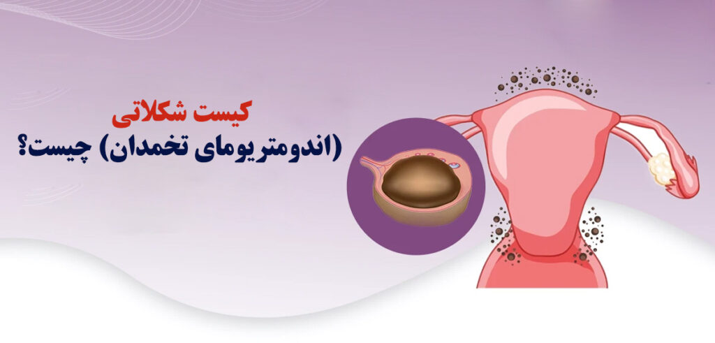 کیست شکلاتی