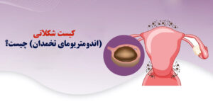 کیست شکلاتی