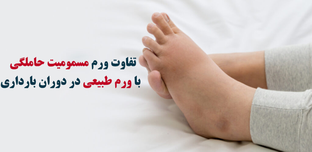 مسمومیت حاملگی