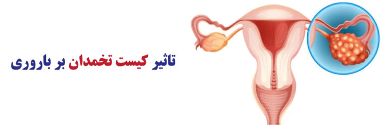 کیست تخمدان