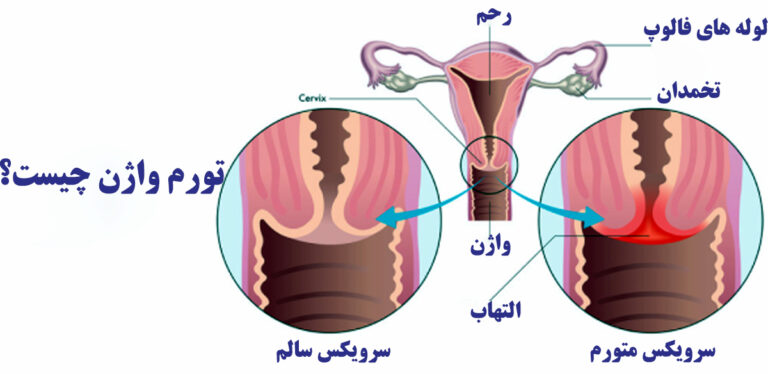 تورم واژن